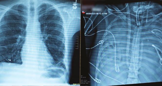 Zdjęcia rentgenowskie pokazują klatkę piersiową pacjenta – najpierw z płucami, a następnie po ich usunięciu. Sztuczny system podtrzymywał chorego przy życiu przez dwa dni – całkowicie bez płuc.