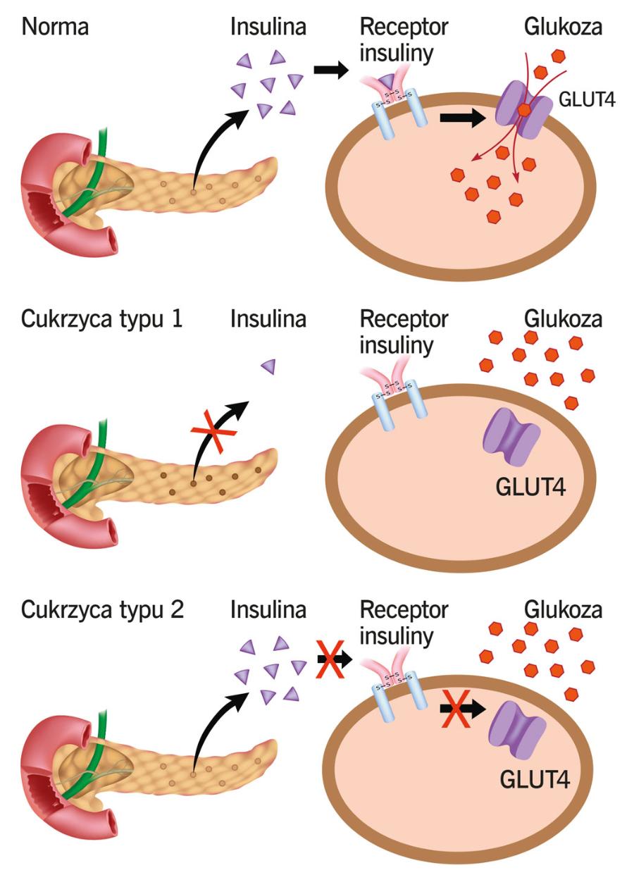 W cukrzycy typu 1 ustaje produkcja insuliny. W typie 2 pojawia się oporność komórek na jej działanie. GLUT4 to transporter glukozy.