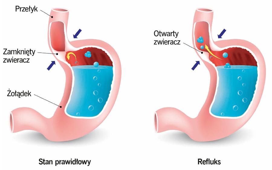 Powstawanie choroby refluksowej przełyku.