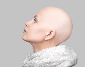 Tylko nieliczni potrafią przyjąć ze spokojem fakt, że łysieją