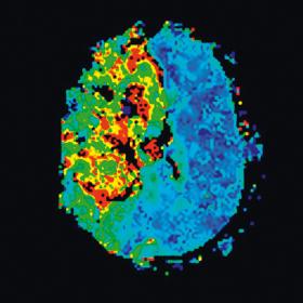 Obraz fMRI (funkcjonalny rezonans magnetyczny) mózgu osoby po silnym udarze.