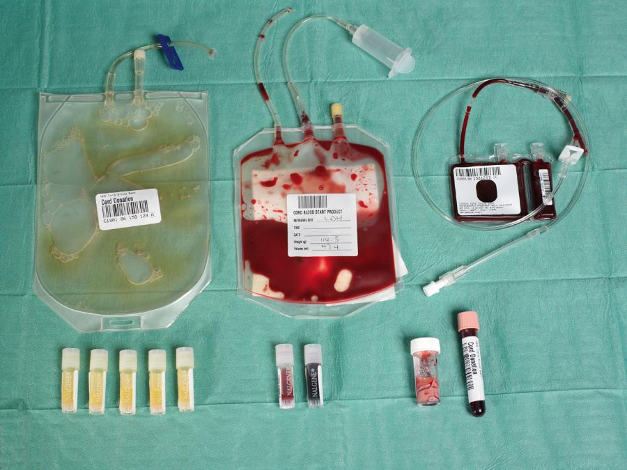 Worek po lewej zawiera osocze; środkowy – krew pozyskaną z łożyska i sznura pępowinowego, z której będą izolowane komórki macierzyste; po prawej – wyizolowane komórki.
